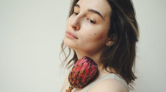 Skincare Tips for Acne-Prone Skin