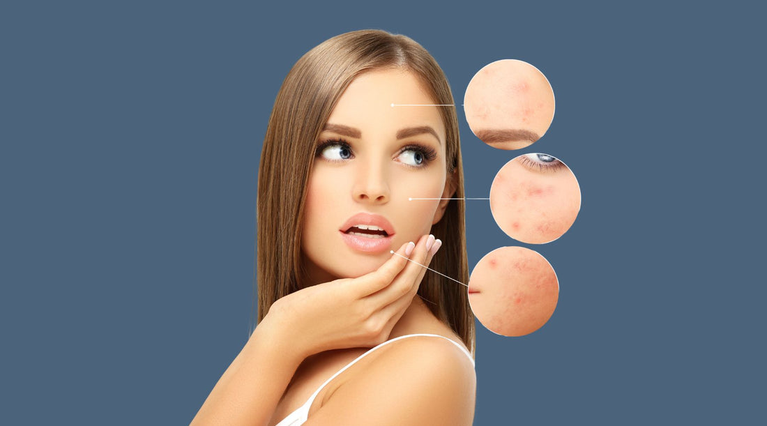 How Long Does it Take for Acne Scars to Disappear?