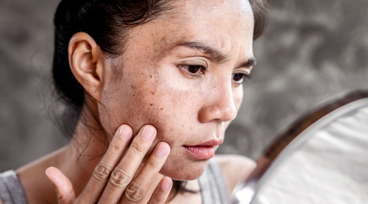 Understanding Hyperpigmentation: Causes and Treatments