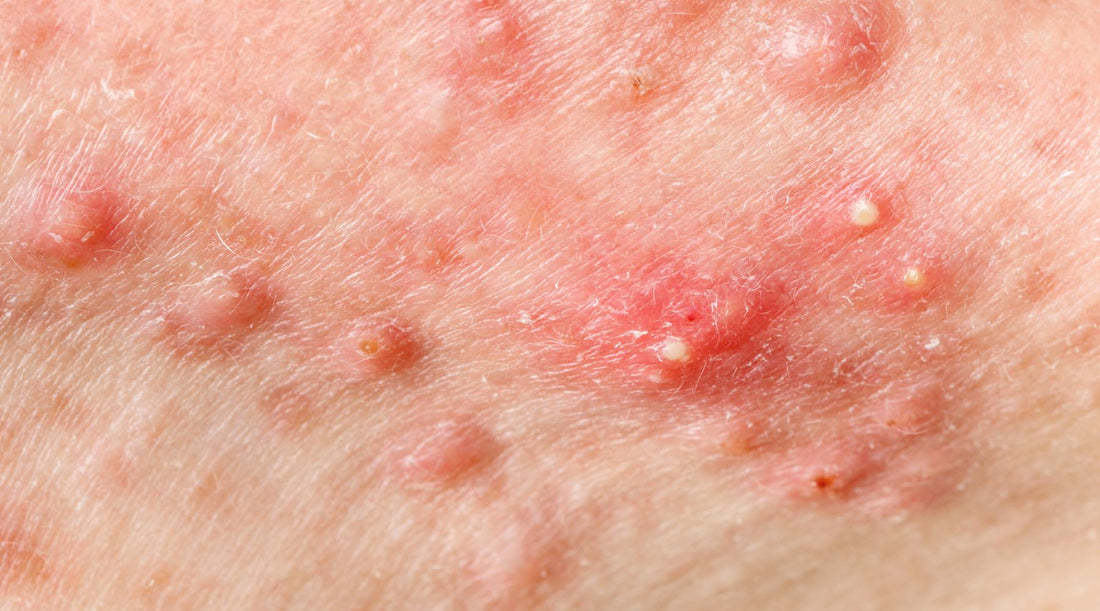 Facts About Hormonal Acne During Your Period