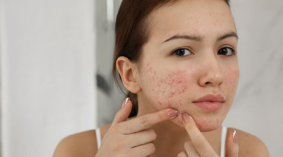 Combatting Acne with Lifestyle Changes