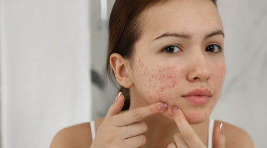 Combatting Acne with Lifestyle Changes