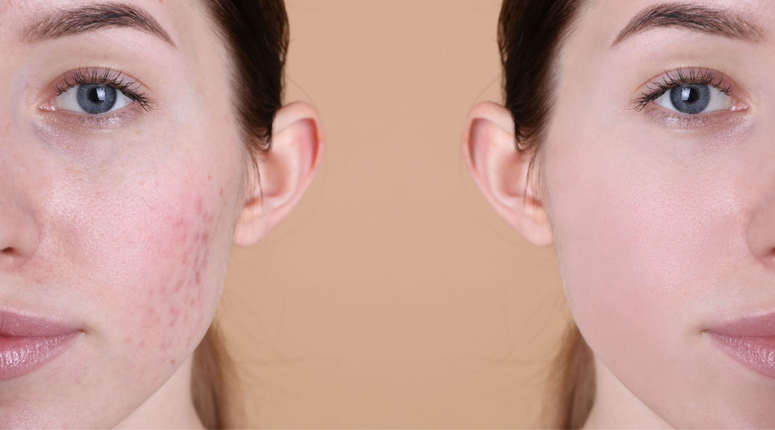 How to Treat Post-Acne Marks and Scars