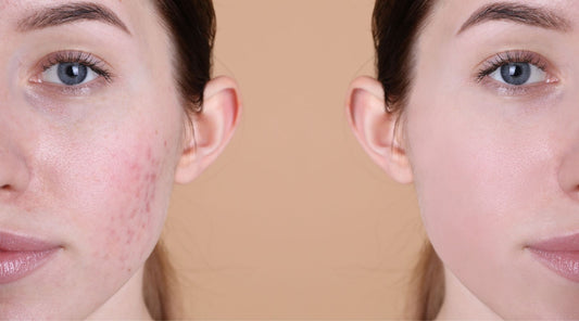 How to Treat Post-Acne Marks and Scars
