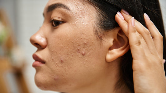 Summer Skin Survival: Beat the Heat Without Breaking Out