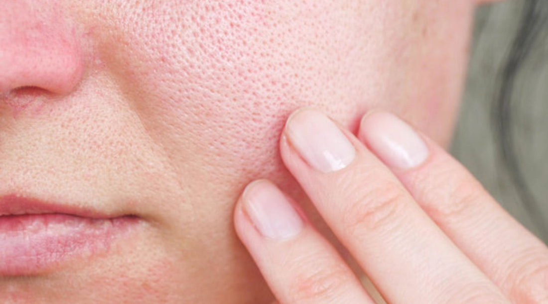 How To Get Rid Of Pores On Face ? Cause And And The Effective Solutions?