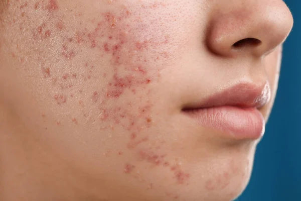 10 Ways How to Remove Pimples Overnight: Your Ultimate Guide