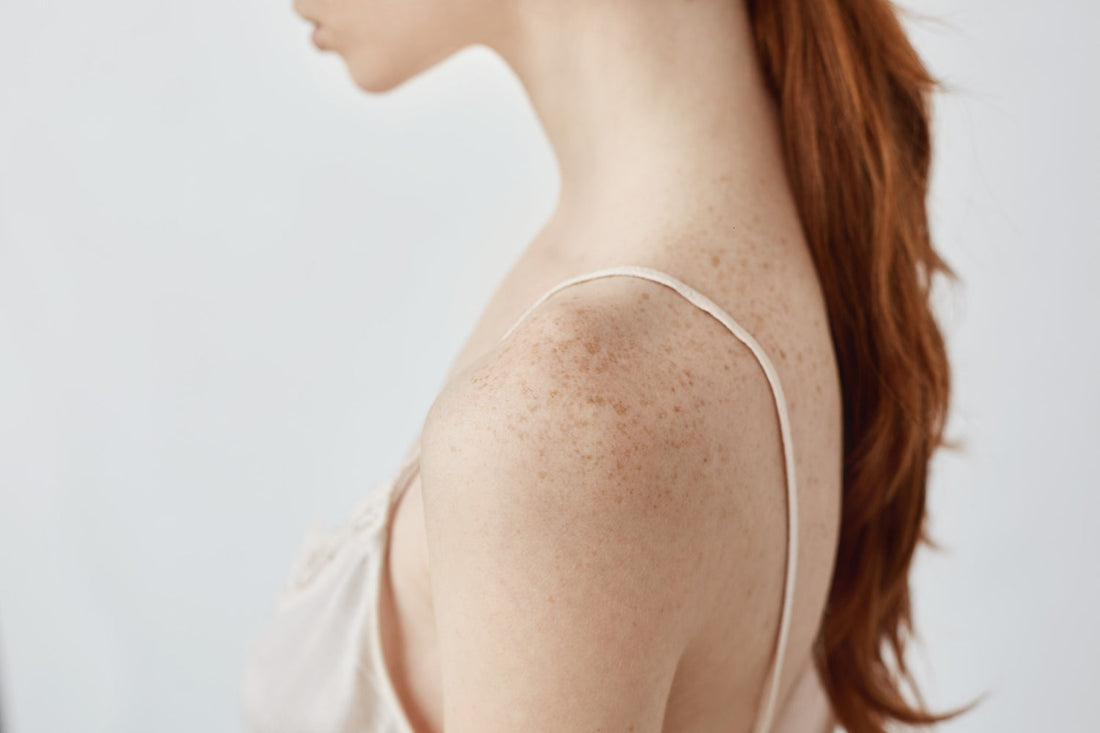 How to Treat (and Prevent) Sun-Induced Hyperpigmentation