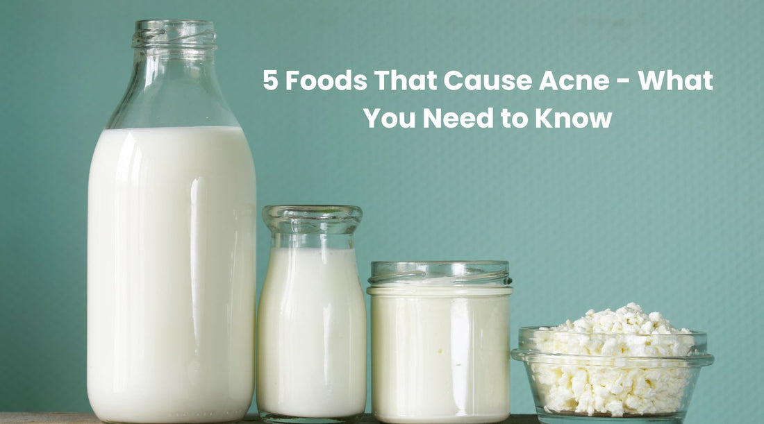 5 Foods That Cause Acne - What You Need to Know
