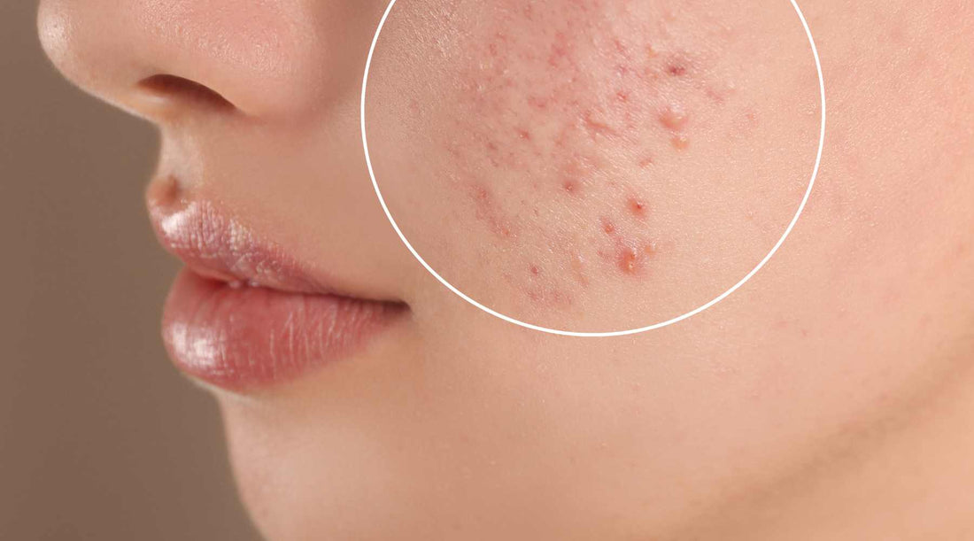 What is Acne? Knowing its Types and the Best Ways to Treat Them