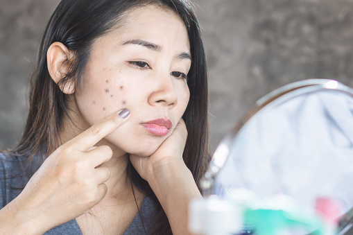 7 Effective Ways to Get Rid of Dark Spots on Your Face: Your Ultimate Guide