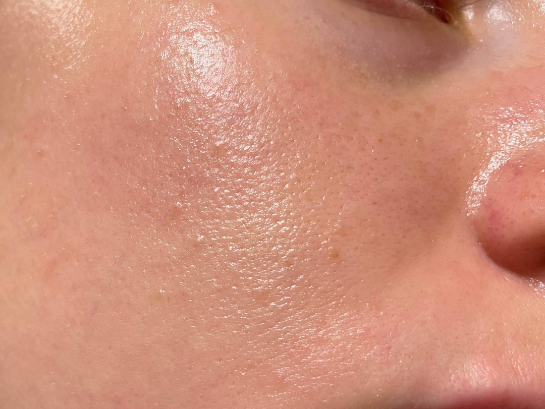 5 Signs Your Skin Needs More Hydration—Even If It Feels Oily