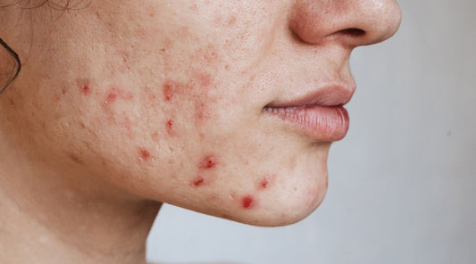 5 Effective Tips to Fight Acne