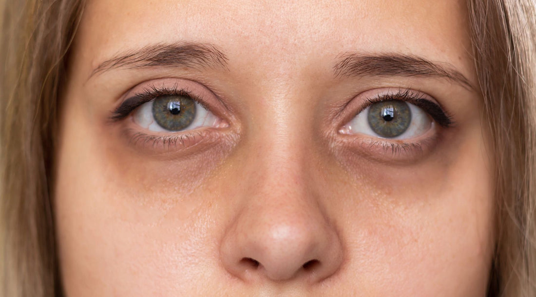 Finding out the Causes: 8 Causes of Eye Bags in Your Early 20s