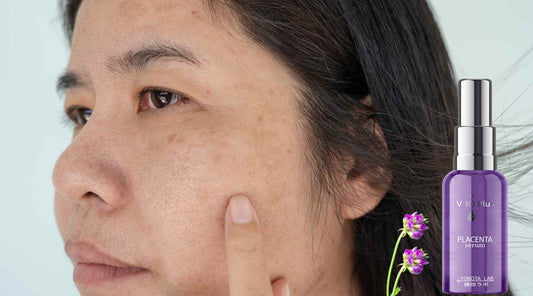 Understanding 3 Common Skin Conditions and the Role of V 10 Plus Placenta Serum