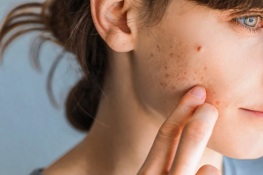 Skincare for Teenagers: Addressing Puberty-Related Skin Problems