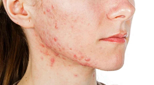 Conquering Cystic Acne: Understanding, Treatment, and Prevention
