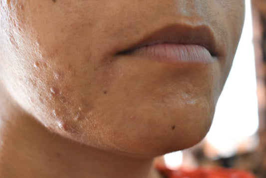 Barrier Repair: The Most Overlooked Step in Skincare 🌟